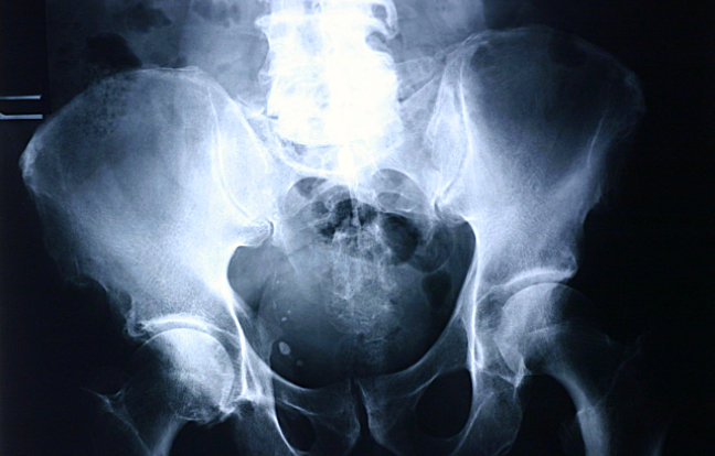 What to Expect After Hip Surgery